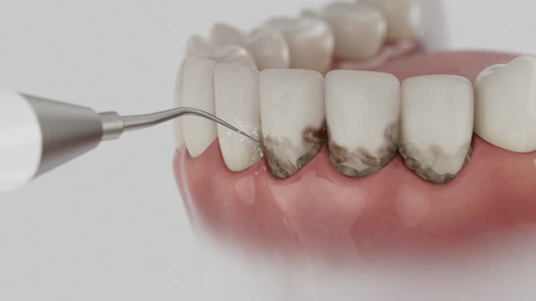 Trusted Wisdom Tooth Removal service in Pajaro, CA - Dentist Open Now